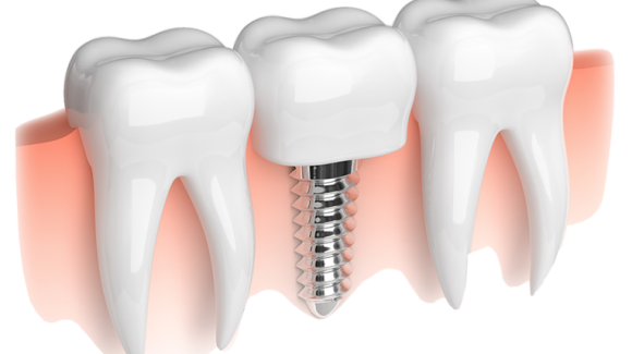 What is dental implant ?