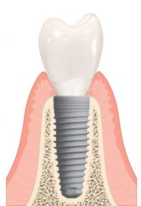 Dental Implant diş implantı